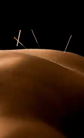 Dry Needling & Acupuncture